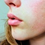 3 Manfaat Tranexamic Acid untuk Melasma dan Flek Hitam, Benar Efektif?