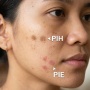 5 Perbedaan PIE dan PIH Bekas Jerawat dan Cara Membedakannya