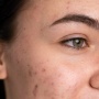 6 Cara Memakai Sunscreen pada Wajah Berjerawat Meradang Tanpa Memicu Komedo