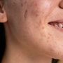 Manfaat Azelaic Acid untuk Memudarkan PIE, PIH dan Meredakan Rosacea di Usia 30+