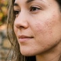 Apakah Serum PDRN DNA Salmon Bisa Membantu Meratakan Tekstur Bekas Jerawat Bopeng?