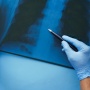 Mengapa Pasien Kanker Bisa Dapat Pengobatan Berbeda Meski Diagnosisnya Sama? Ini Penjelasannya