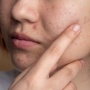Perbedaan Chemical, Physical, dan Hybrid Sunscreen: Mana yang Paling Cocok untuk Jerawat?