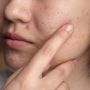 7 Cara Mengatasi Wajah Breakout dan Bruntusan Akibat Salah Moisturizer