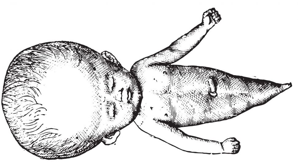 Ребенок человек русалка. Сиреномелия заболевание.