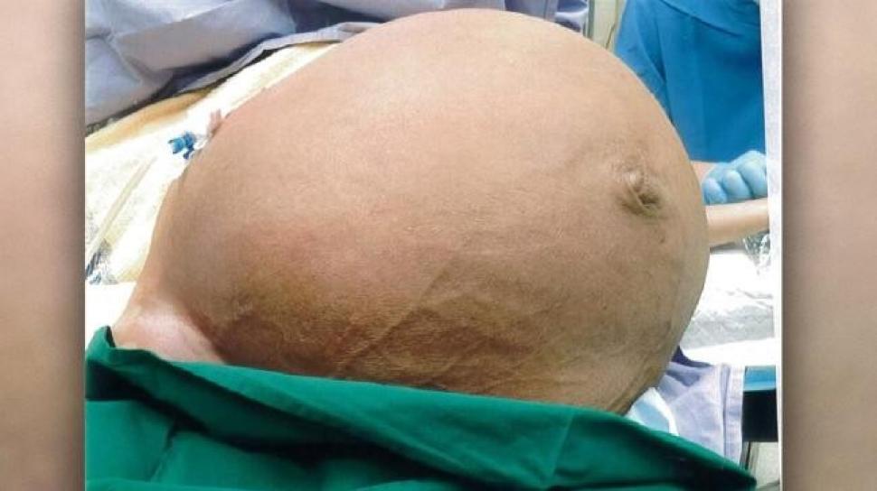 Tumor Raksasa Seberat 28 Kg Tumbuh Di Rahim Perempuan Singapura