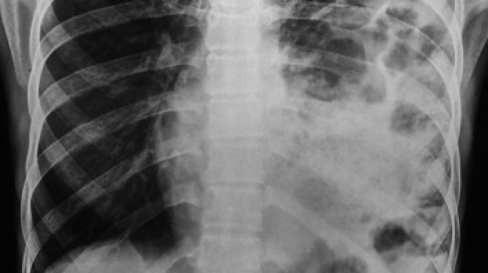 CT Scan diafragma yang terisi usus (Science Direct Journal)