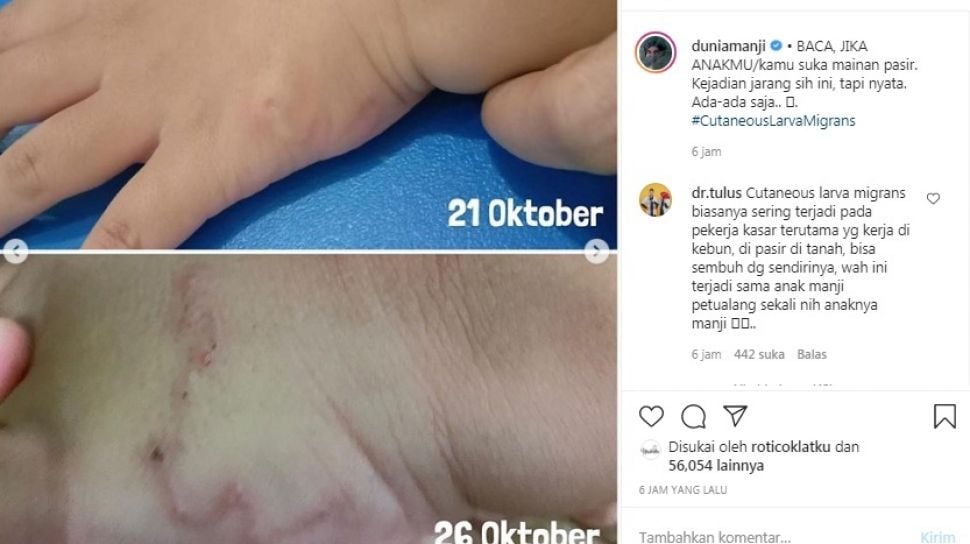 Penyebab Gejala Dan Cara Mengobati Cutaneous Larva Migrans