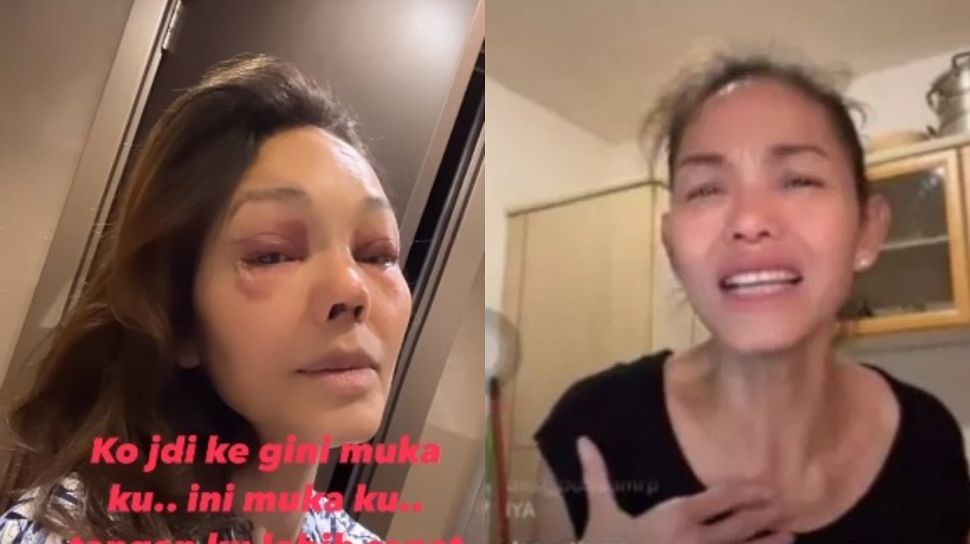 Wajah Bunda Corla Lebam-lebam Diduga Oplas, Warganet Gak Respek Lagi dan Pilih Unfollow