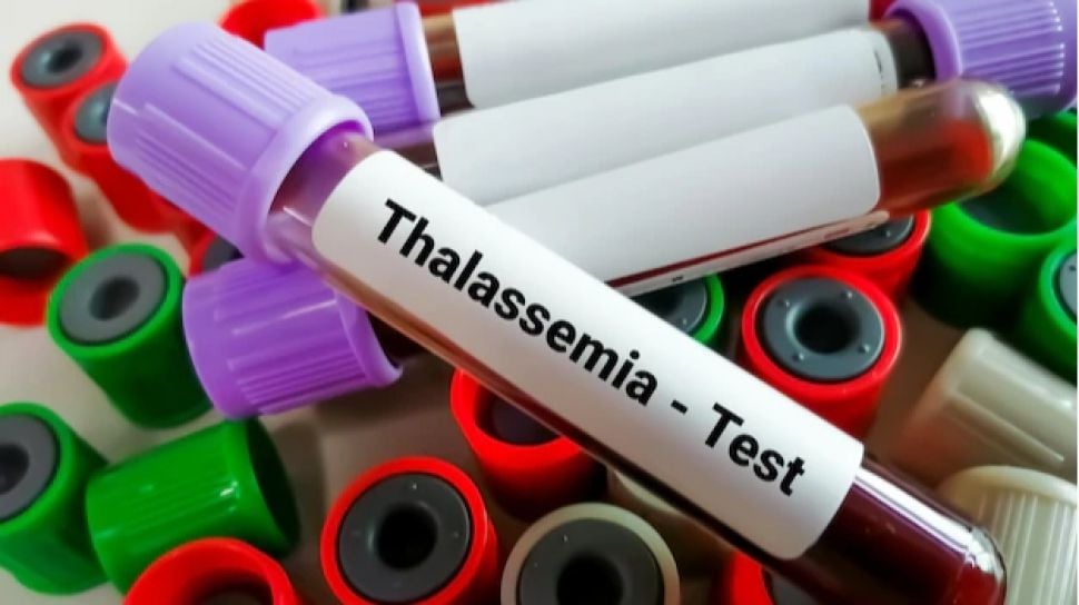 Apa Itu Penyakit Thalasemia? Begini Pengertian, Gejala dan Penyebabnya