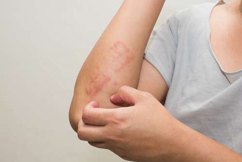 Seseorang menderita Psoriasis (Shutterstock)