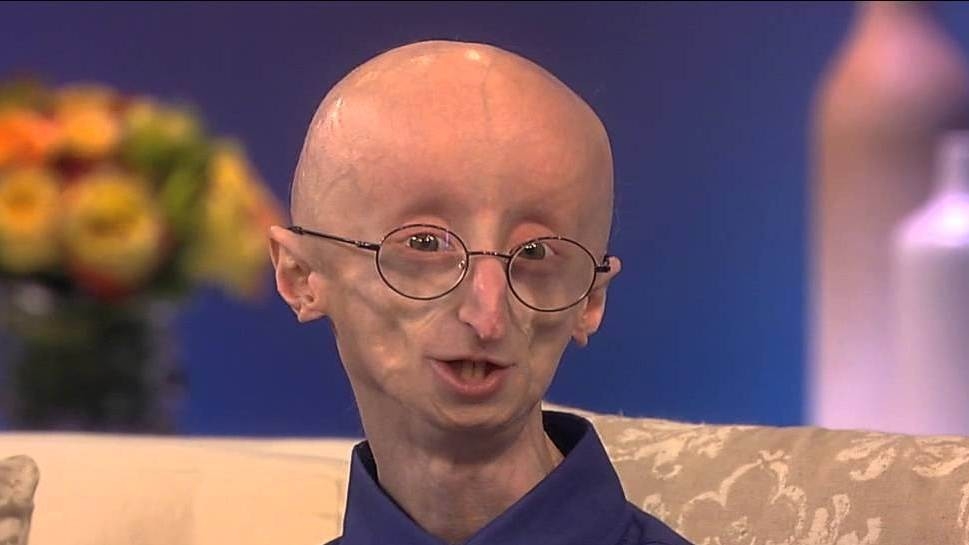 Progeria [Foto: Youtube]