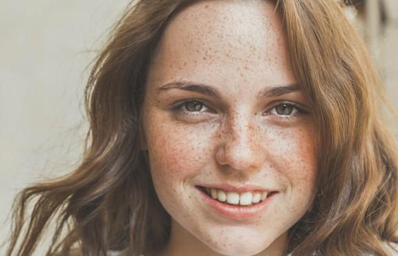 Freckles. (iStock)