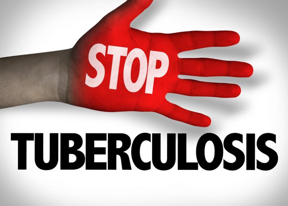 Tuberkulosis (TBC) masih jadi beban di Indonesia. (Shutterstock)