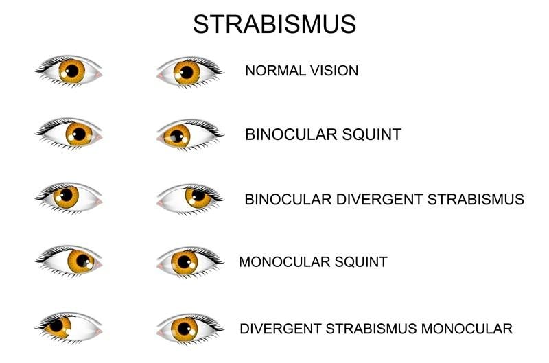 Strabismus atau mata juling [shutterstock]