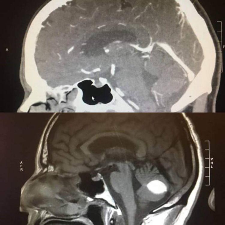 Tumor di kepala Paul Wood yang mendadak hilang jadi Viral [Paul Wood Facebook]