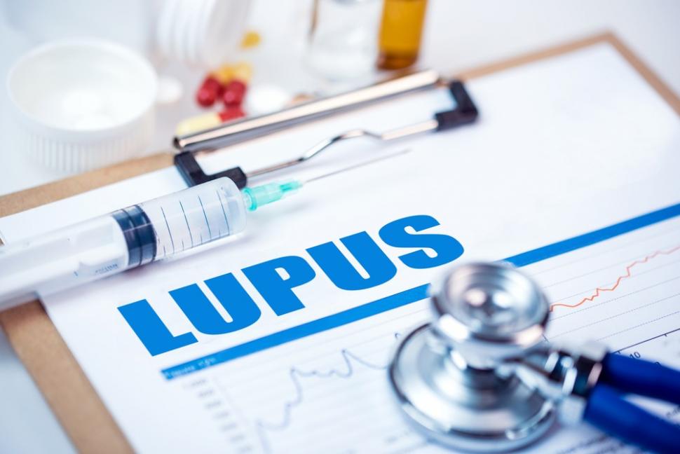 Penyakit lupus. (Shutterstock)