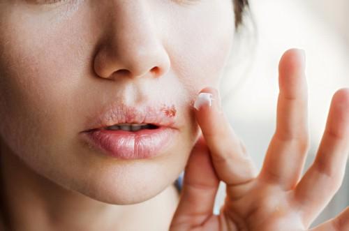 Ilustrasi perbedaan gejala sariawan dan herpes di mulut. (Shutterstock)