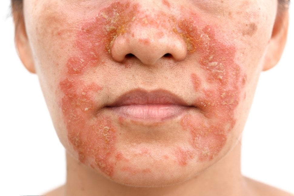 Eksim, penyakit kulit yang bisa membuat kulit bersisik dan kemerahan. (Shutterstock)