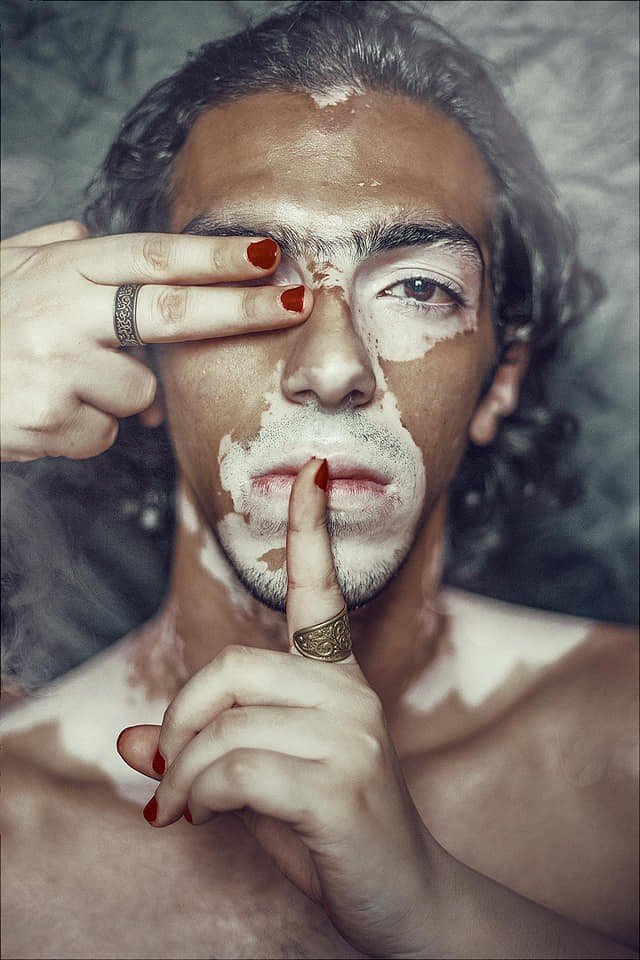 Model vitiligo Mahmoud Hassan. (Facebook/Mahmoud Hassan Mohamed)