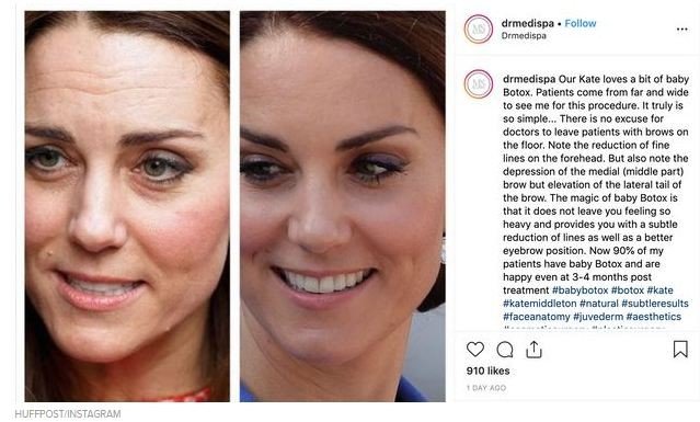 Kate Middleton diduga pakai botox [ig @huffpost]