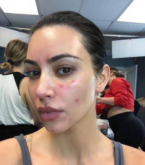 Kim Kardashian curhat psoriasis. (Instagram/@poosh)