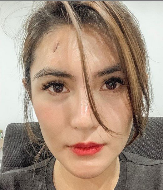 Angela Lee menunjukkan luka di kepalanya. [Instagram]