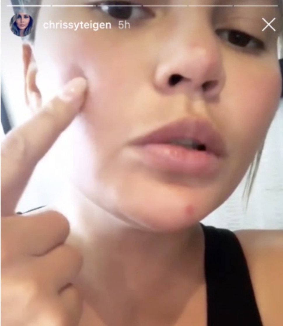 Chrissy Teigen Menunjukkan Kulit Berjerawatnya. (Screenshoot Instagram/@chrissyteigen)