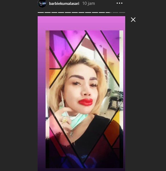 Penampilan Barbie Kumalasari usai sulam bibir. [Instagram]