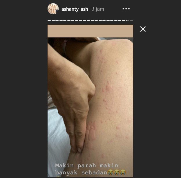 Seluruh tubuh Ashanty dipenuhi ruam dan bentol. [Instagram]