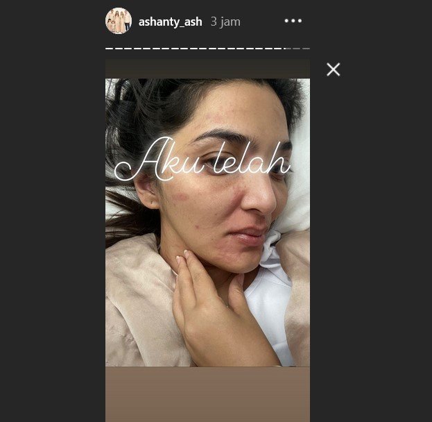 Ashanty dengan wajah yang dipenuhi ruam. [Instagram]