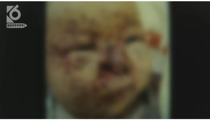Wajah bayi yang digerogoti tikus (Kunming Radio and TV Station)