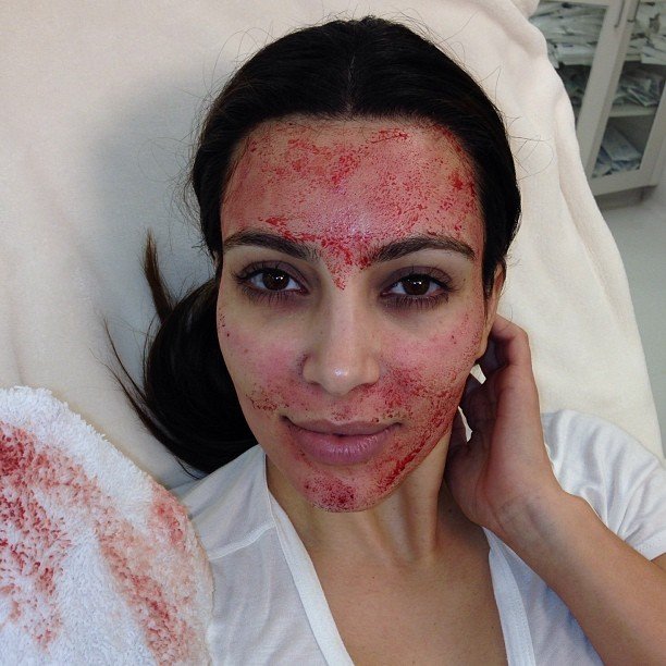 Vampire Facial yang pernah dilakukan Kim Kardashian (Instagram)