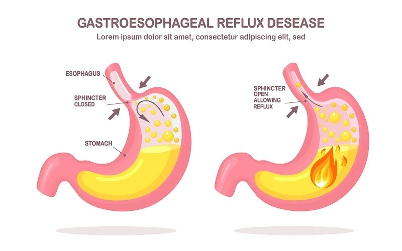 Ilustrasi penyakit GERD dan asam lambung. (Shutterstock)