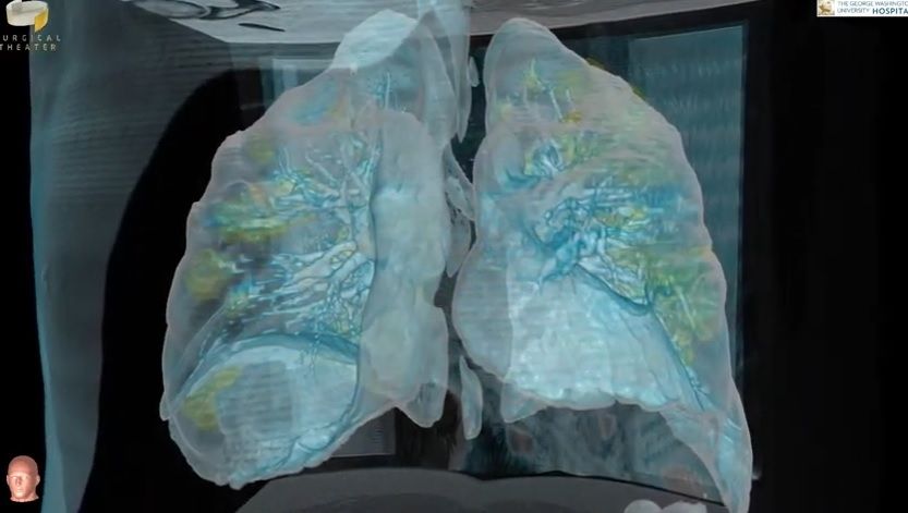 Cuplikan foto dari video 3D paru-paru pasien Covid-19 di Amerika Serikat. [Youtube/Surgical Theater]