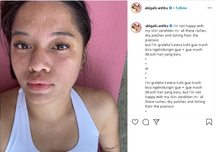 Mengenal Psoriasis, Penyakit yang Dialami Musisi Cantika Abigail