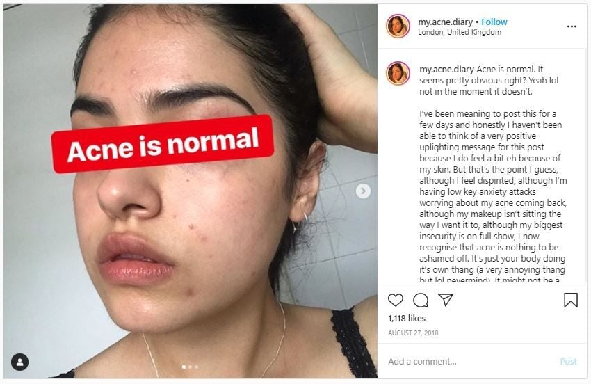 Wajah Penuh Jerawat, Wanita Ini Tak Malu Unggah Fotonya (instagram.com/my.acne.diary)