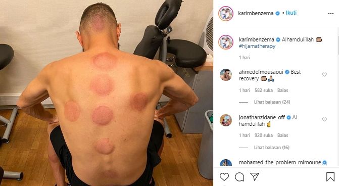 Karim Benzema melakukan terapi bekam. (Instagram/@karimbenzema).