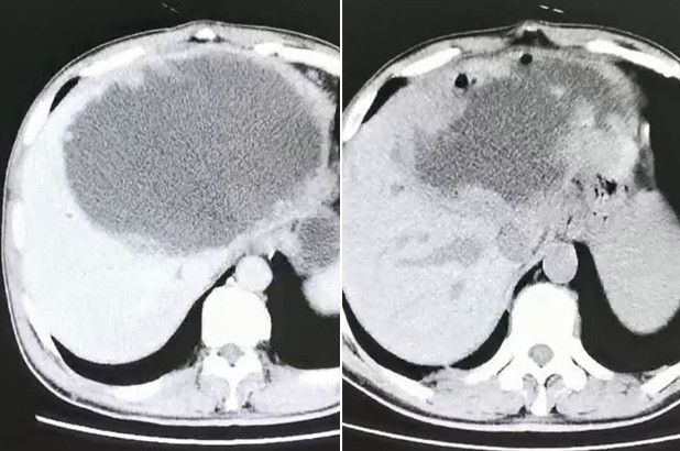 Liver penuh cacing. (Dok: Hangzhou First People's Hospital)