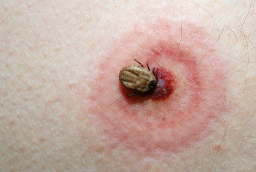 Ilustrasi kutu penyebab tick borne virus. (Shutterstock)