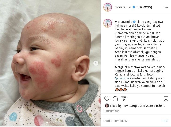 Mona ratuliu bagikan pengalaman saat bayinya kena eksim. (Instagram/@monaratuliu)