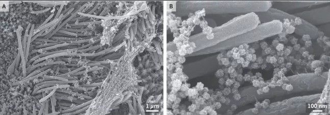 Penampakan Saluran Napas Manusia yang Dipenuhi Virus Corona. (The New England Journal of Medicine/Live Science)