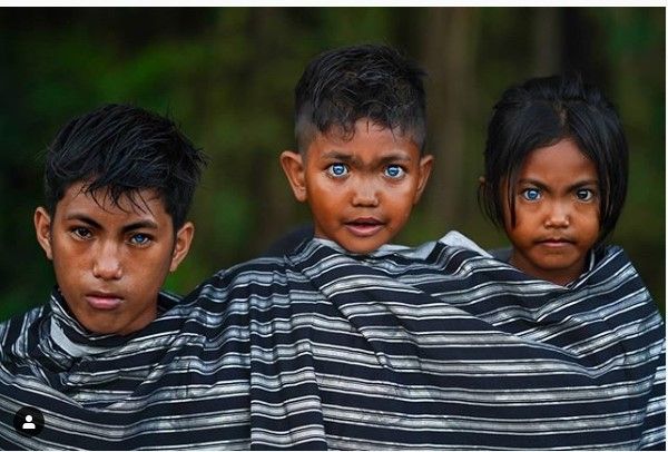 Waardenburg Syndrome pada anak di Kendari, Sulawesi Tenggara. (Dok: Instagram/geo.rock888)