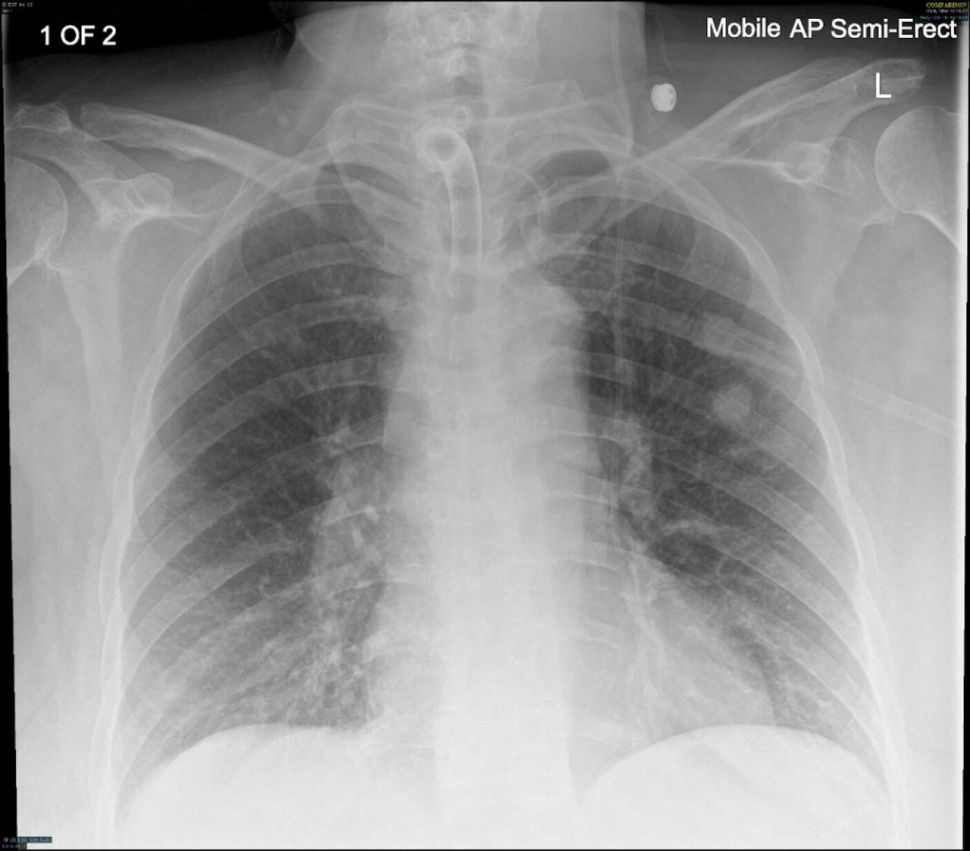 Hasil CT Scan paru-paru sang pria (BMJ Journal)