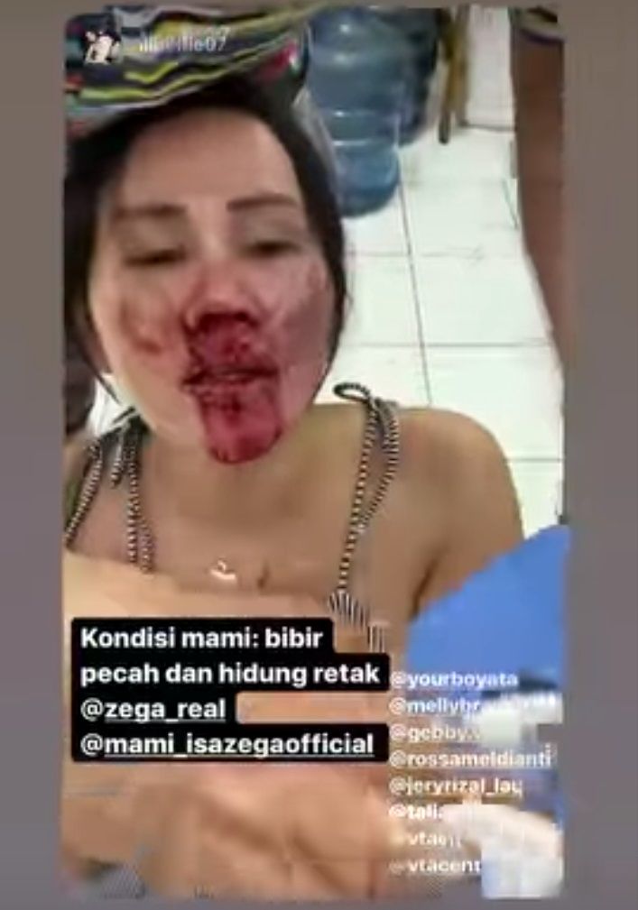 Adrena Isa Zega alias Mami Isa wajahnya bonyok usai dipukul dua lelaki tak dikenal. [Instagram]