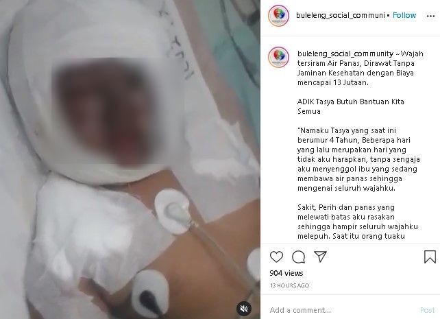 Wajah tersiram air panas, balita Tasya butuh bantuan. (Instagram/@buleleng_sosial_community)