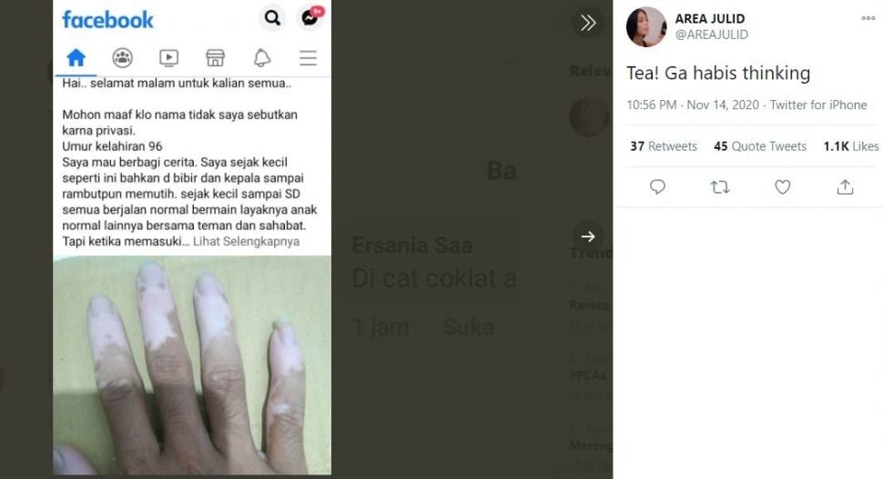 Curhat Vitiligo Dapat Komentar Body Shaming (twitter.com/AREAJULID)