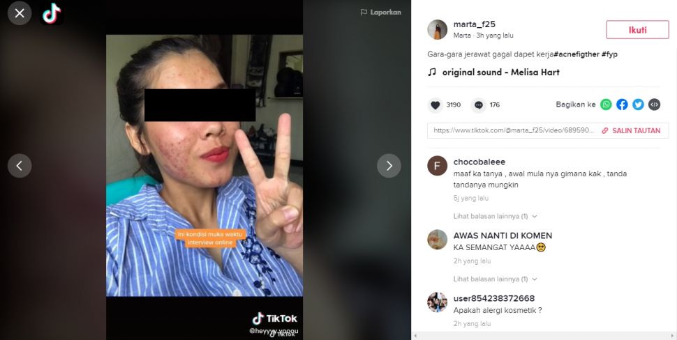 Viral Kisah Wanita Tidak Diterima Kerja karena Jerawat (TikTok/marta_f25).