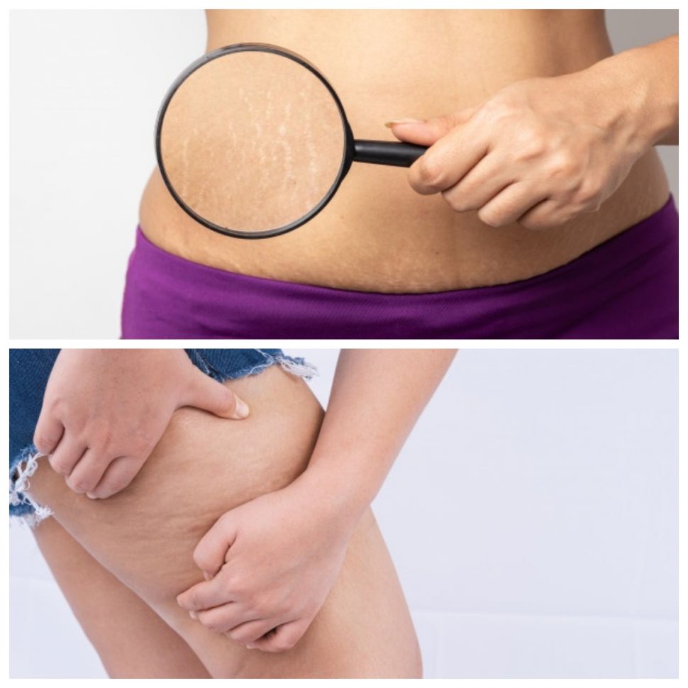 Perbedaan stretch mark dan selulit (Freepik)