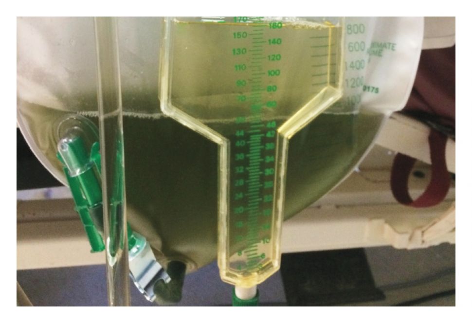 Urine sang pria berubah hijau keruh (NEJM)